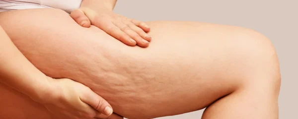 Comment combattre la cellulite