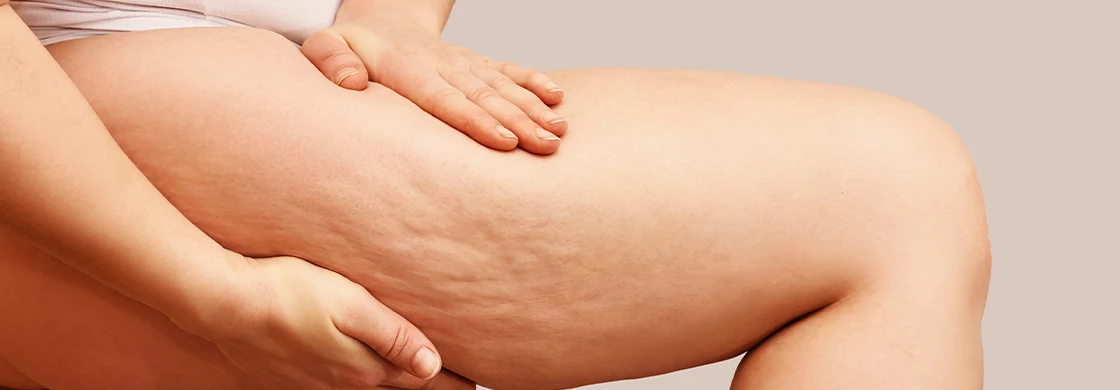 Comment combattre la cellulite