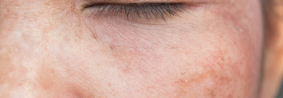 eau eliminerait les taches sur le visage